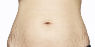 Reduce las estrías fácilmente Reduce las estrías fácilmente