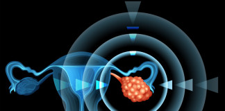 Conoce más acerca del cáncer de ovarios