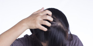 Remedios y cuidados para detener la caspa