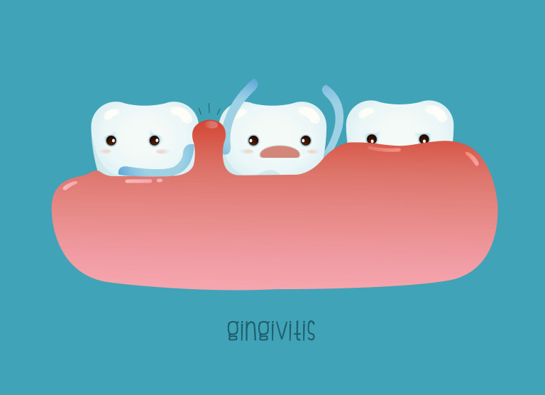 ¿Qué es la gingivitis?