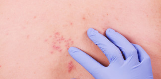 Zóster, enfermedad causada por el virus de la varicela