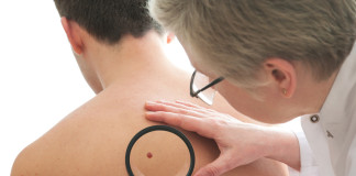 ¿Porqué te salen los lunares?