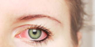 Remedios caseros para los ojos rojos