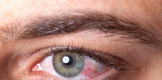 ¿Qué es la conjuntivitis?