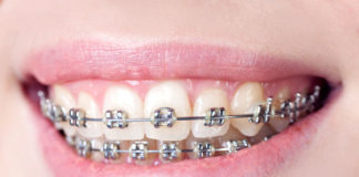 Cómo evitar el dolor que provocan los brackets