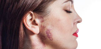 Manchas de nacimiento