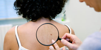 Conoce los signos del cáncer de piel