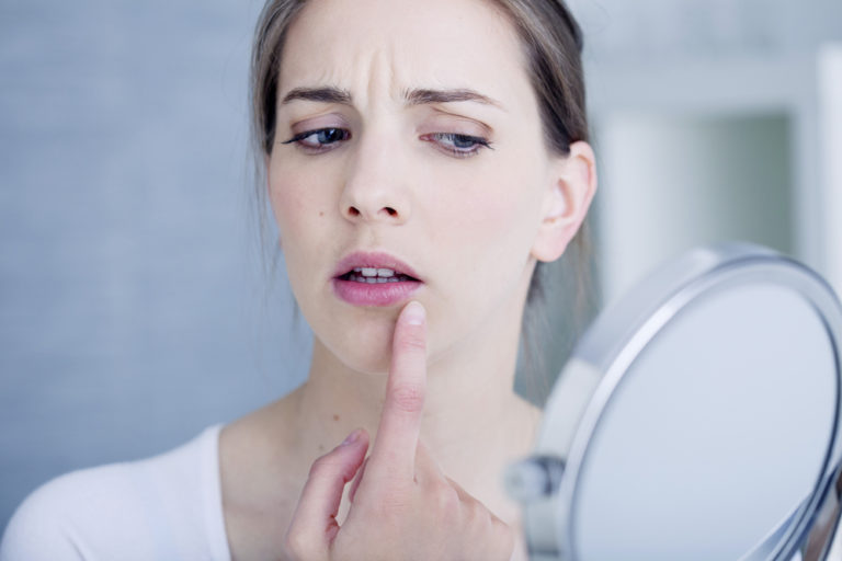 Herpes labial, cómo curarlo y evitar su contagio