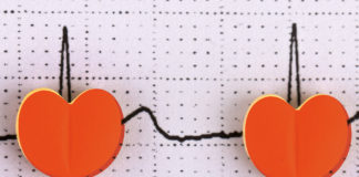 Fibrilación auricular: una epidemia del siglo XXI