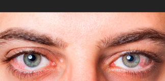 Manchas en la zona blanca del ojo
