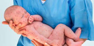 La enfermedad que se había erradicado y volvió por no vacunar