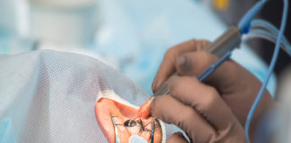 Las ventajas y desventajas de la cirugía láser ocular