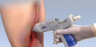 Desarrollan pegamento médico para sanar heridas graves